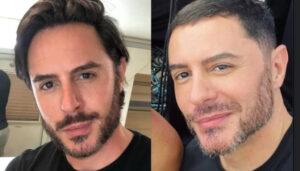 Desarmonização: famosos revertem procedimentos e buscam aparência natural